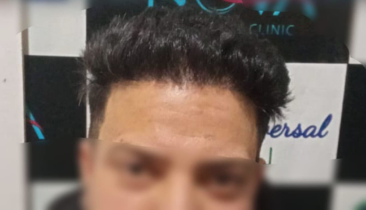 After Hair Transplant - Patient 1