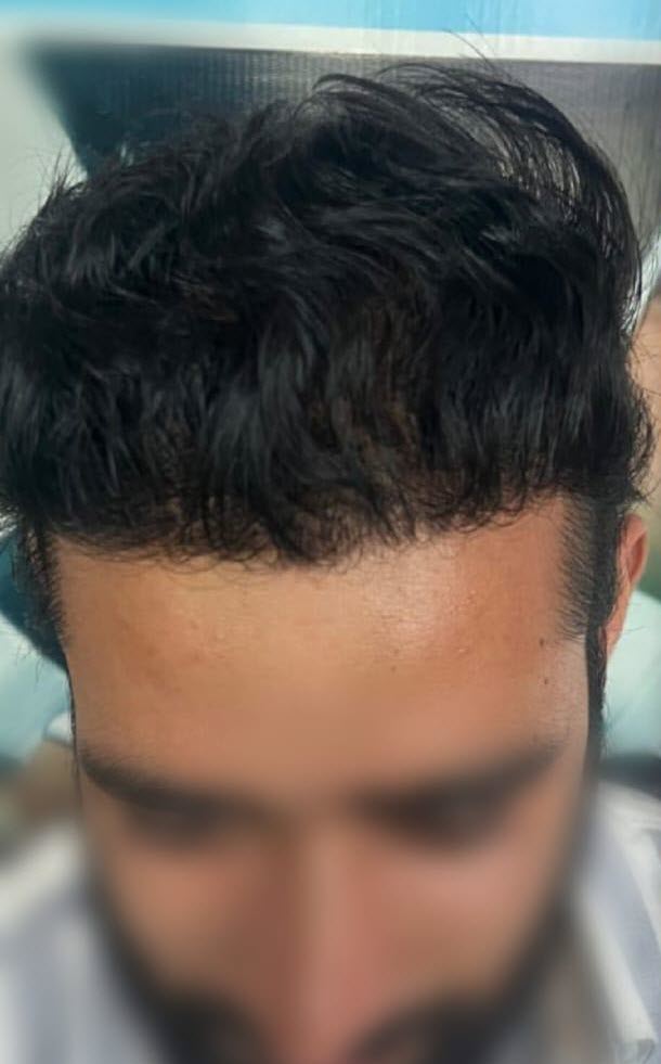 After Hair Transplant - Patient 2