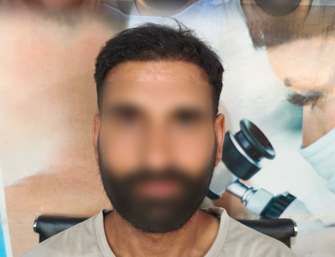After Hair Transplant - Patient 3