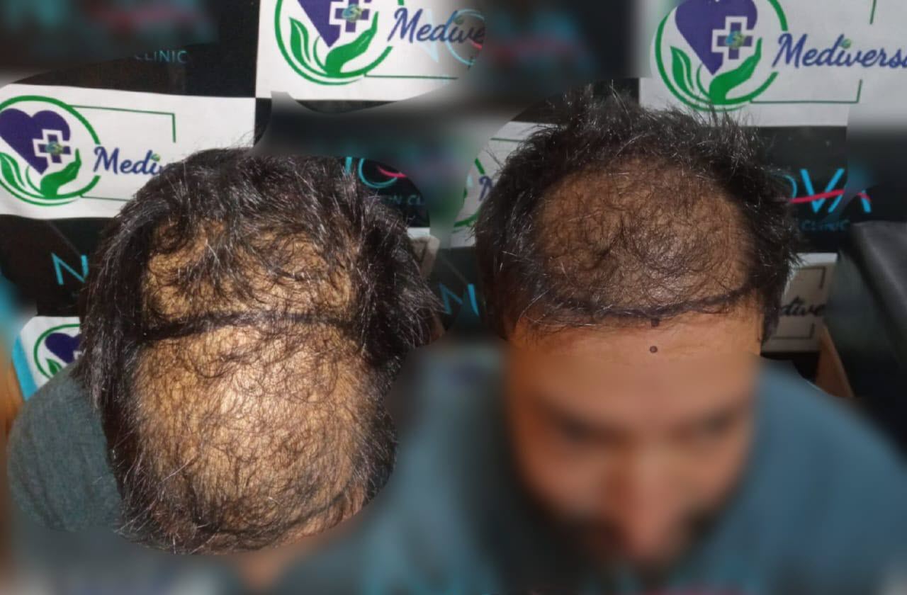 Before Hair Transplant - Patient 1