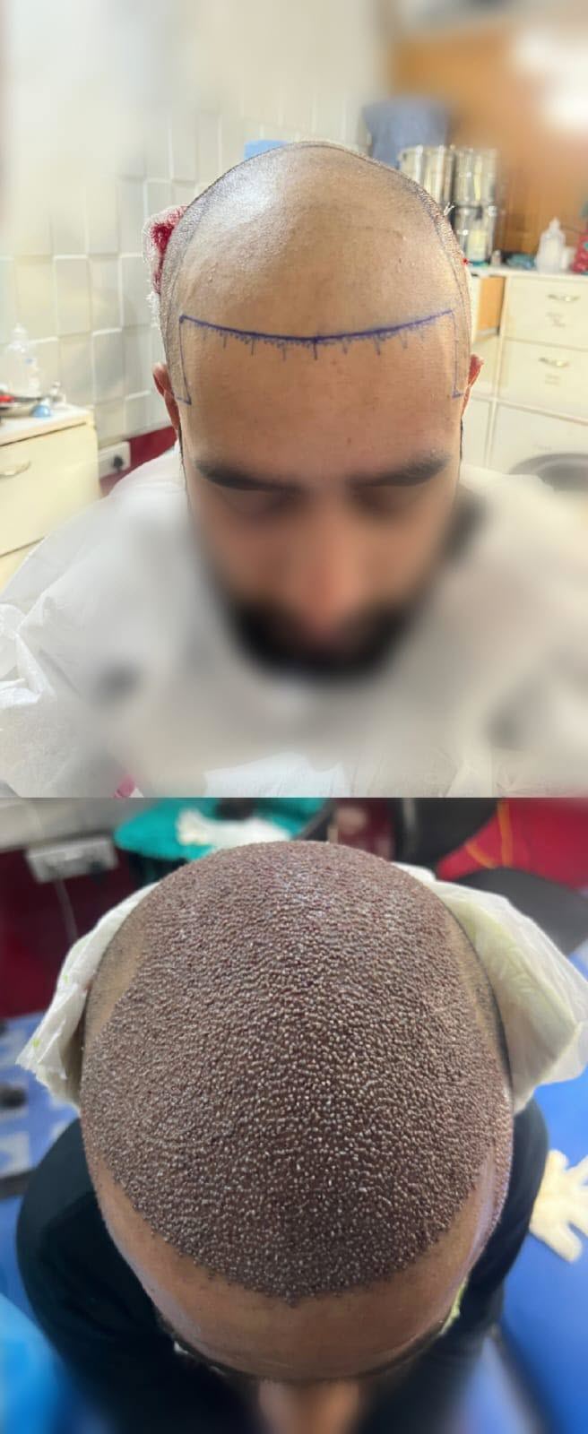 Before Hair Transplant - Patient 2