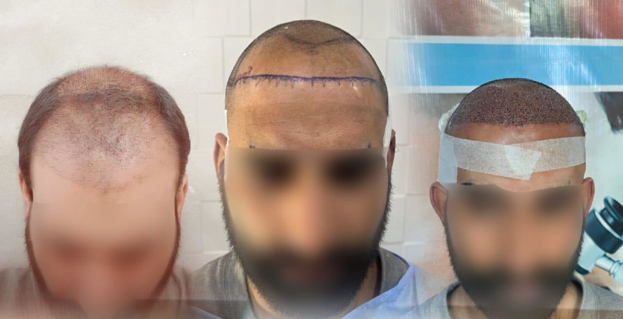Before Hair Transplant - Patient 3