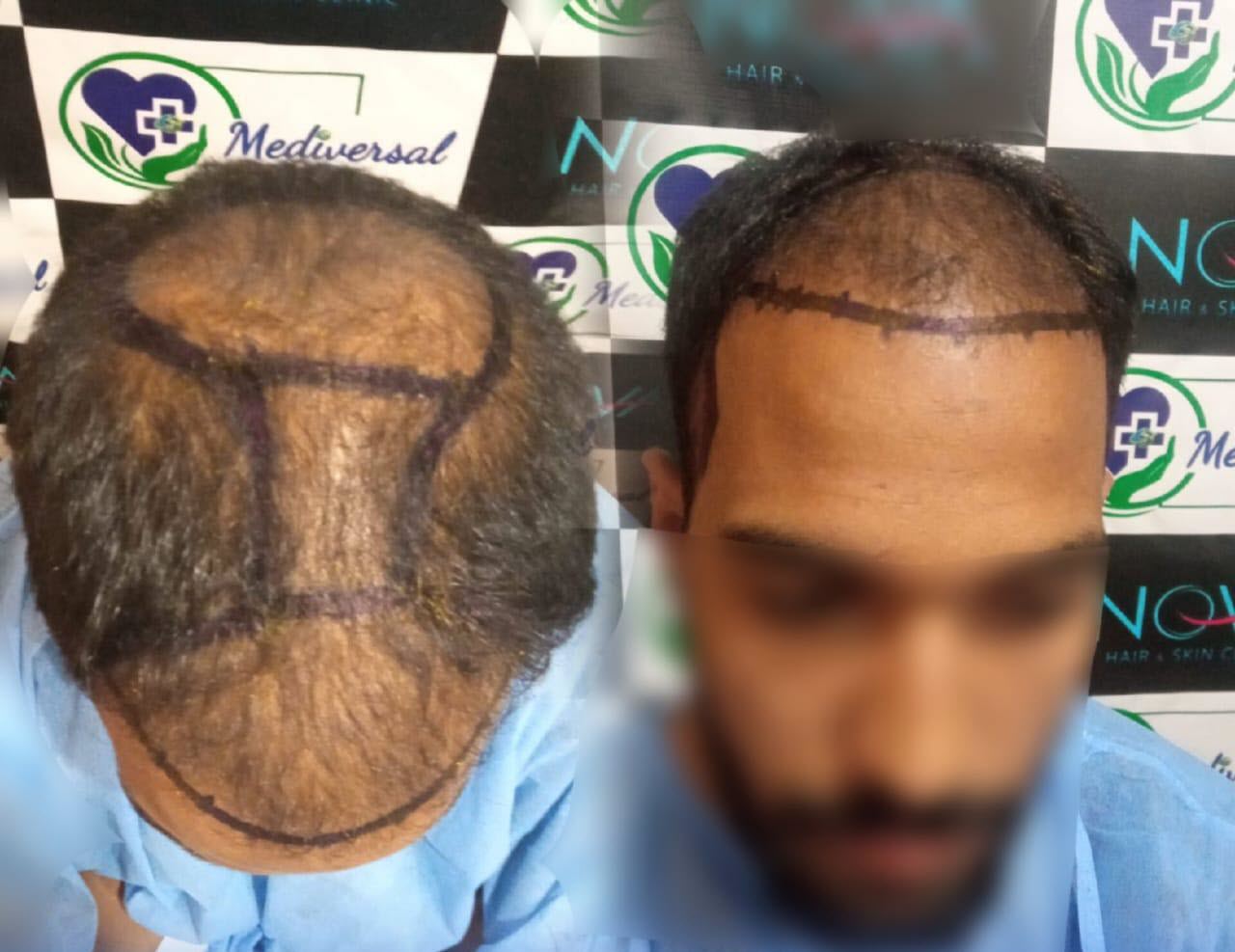 Before PRP - Patient 4